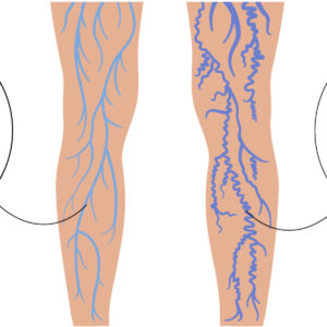 Insights from a Varicose Vein Awareness Session: Key Highlights